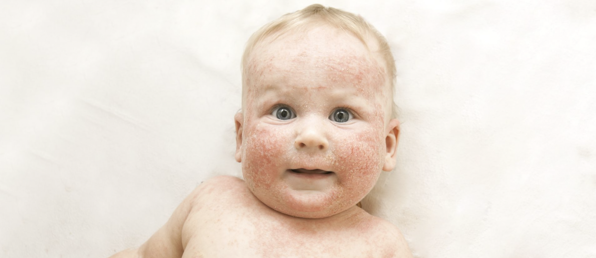Infant Allergies Reflux Colic Infant allergies reflux colic